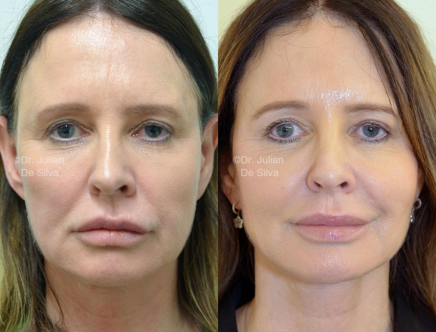 Female face, before and after Mini Facelift treatment, front view, patient 1