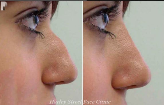 Non-Surgical Treatments — female nose, before and after treatment, side view