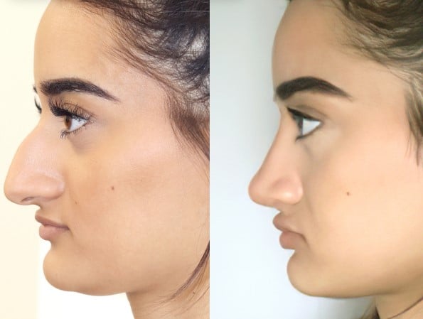 Dr. Julian De Silva’s Perspective — female nose, before and after treatment, side view