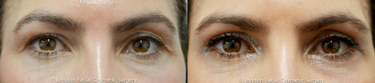 You can get rid of dark circles permanently through lower eyelid surgery.