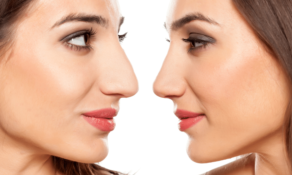 Fleshy noses, also called meaty or fat noses, have prominent protruding appearances.