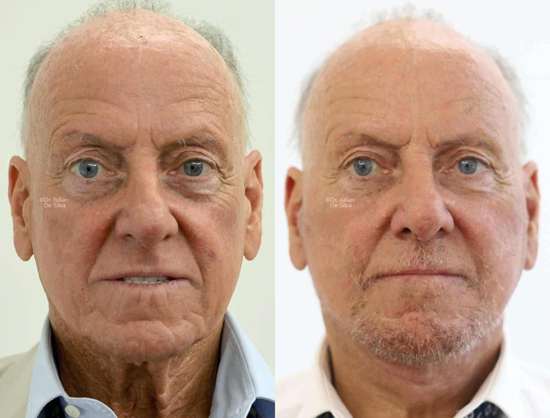 Male face, before and after Mini Facelift treatment, front view, patient 4
