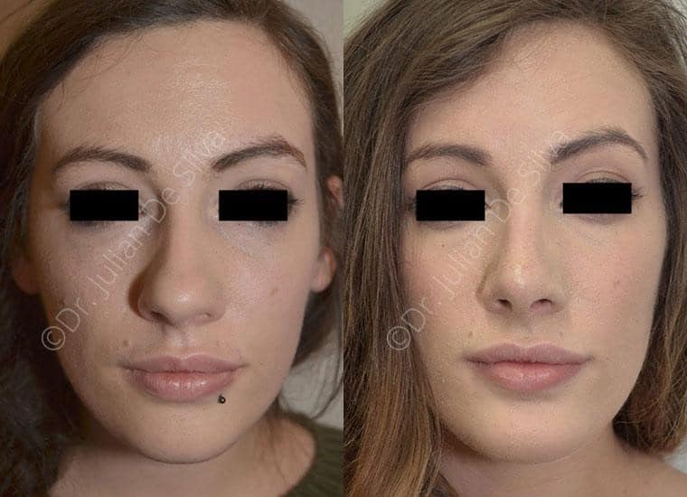Female face, before and after Nose Jobs treatment, front view, patient 6