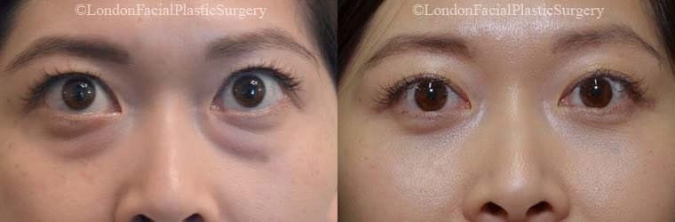Asian Female eyes, Before and After Eye Lift treatment, front view, patient 5