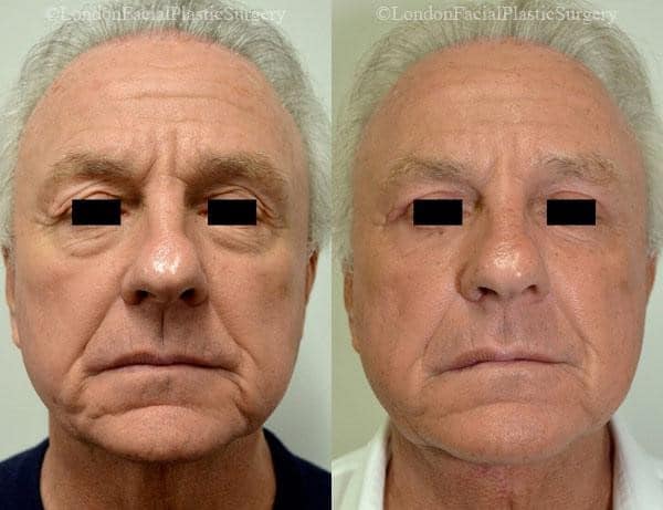 Male face, before and after Mini Facelift treatment, front view, patient 2
