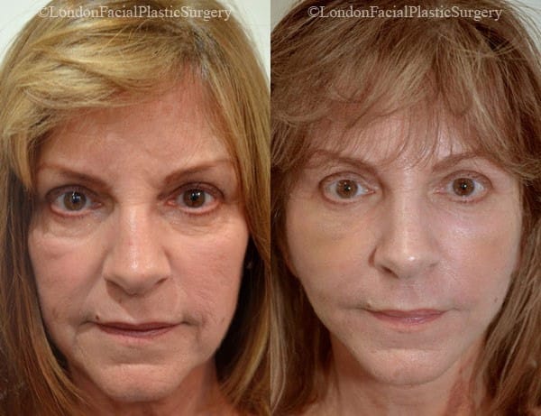 Female face, before and after Mini-Facelift treatment, front view, patient 1
