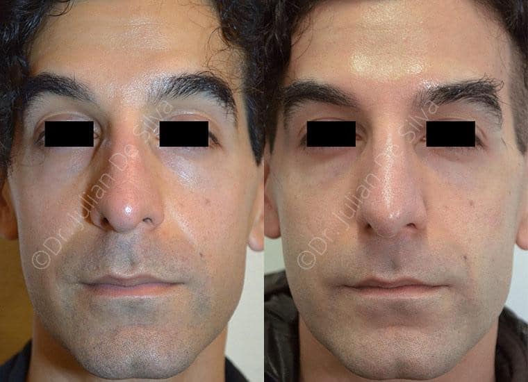Male face, before and after Nose Jobs treatment, front view, patient 5