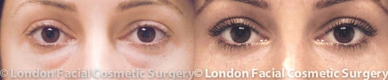 Female eyes, Before and After Eye Lift treatment, front view, patient 3