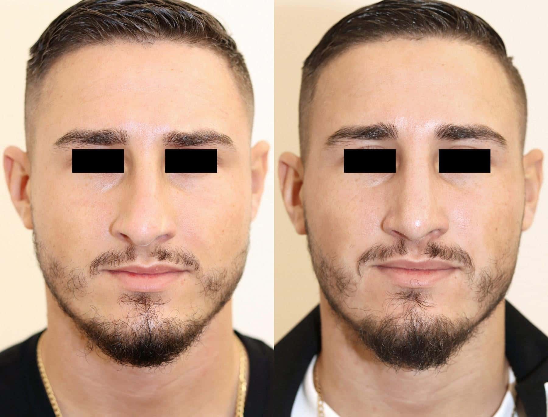 Male face, before and after Nose Jobs treatment, front view, patient 7