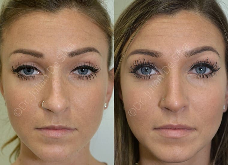 Female face, before and after Nose Job Transformation treatment, front view, patient 5