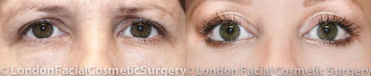 Before and After Crow’s Feet and Under Eye Wrinkles Surgery Photos, front view, patient 1
