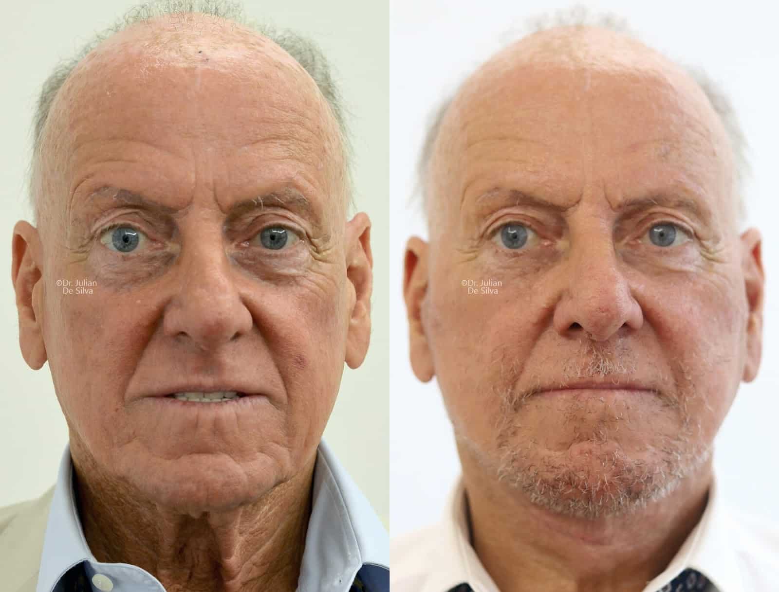 Male face, before and after Neck Lifting treatment, front view, patient 2