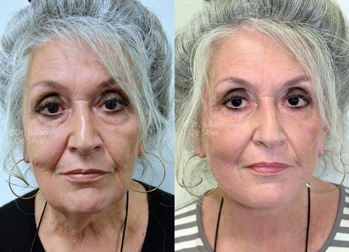 Female face, before and after Face Lift treatment, front view, patient 3