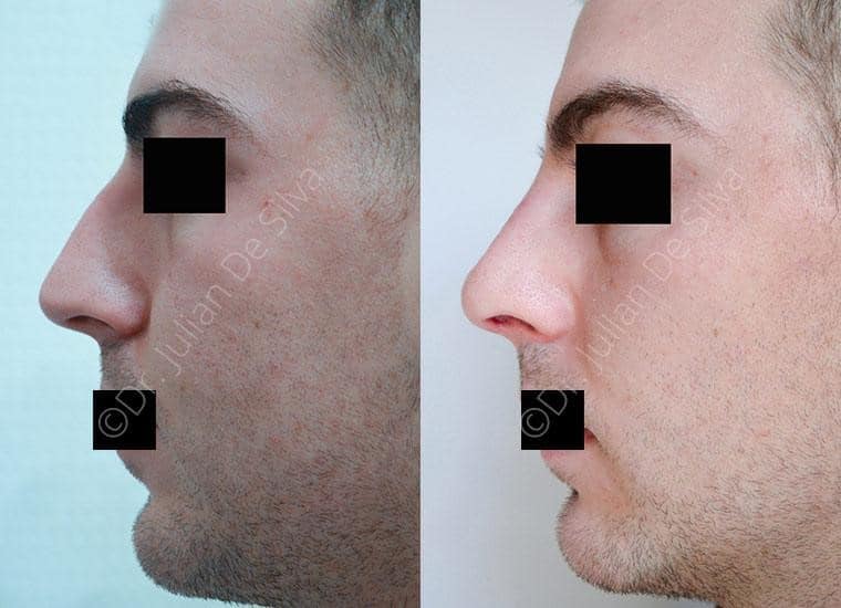 Male face, before and after Nose Jobs treatment, side view, patient 3