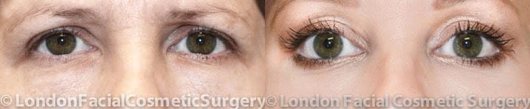 Female eyes, Before and After Eye Lift treatment, front view, patient 1