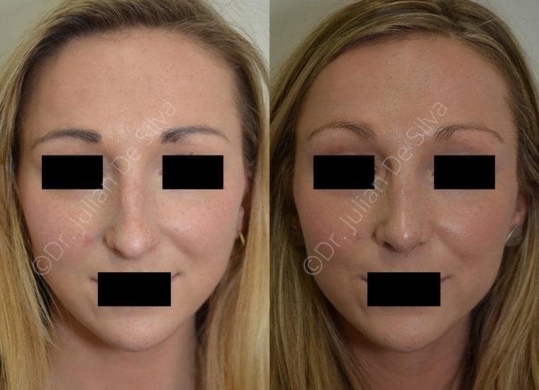 Female face, before and after Nose Jobs treatment, front view, patient 4