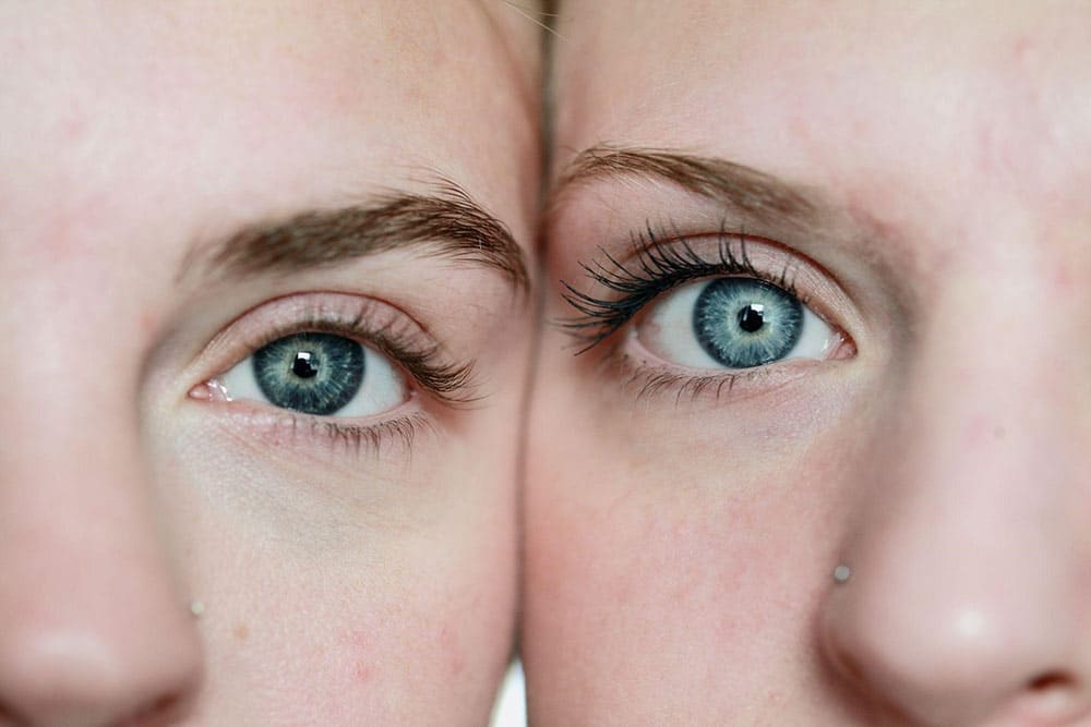 Eyelid Surgery: female eyes ba, model