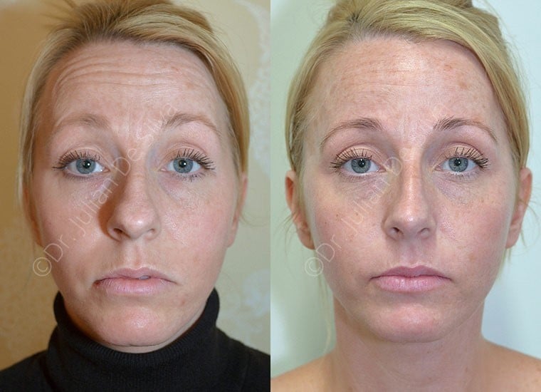 Female face, before and after Nose Job Transformation treatment, front view, patient 2