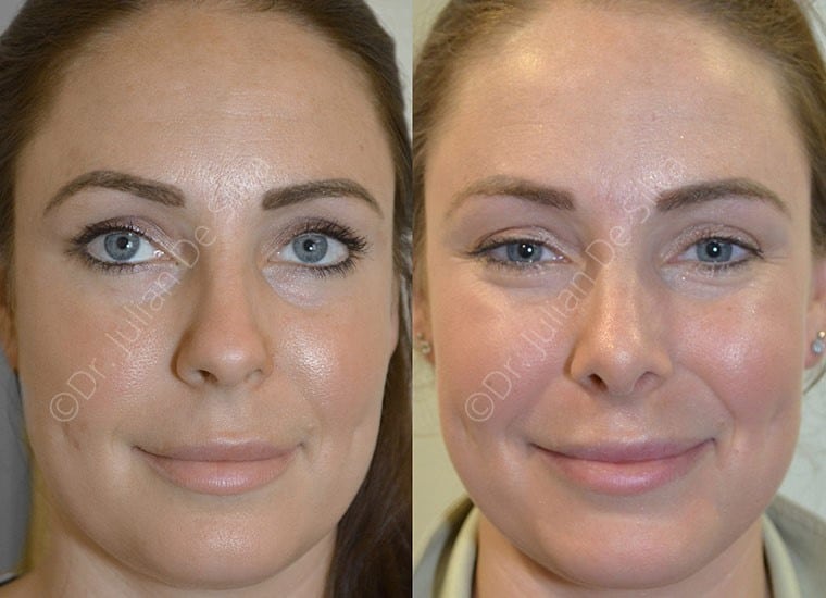 Female face, before and after Nose Job Transformation treatment, front view, patient 3