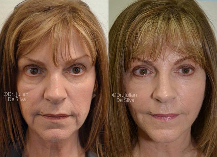 Female face, before and after Face Lift treatment, front view, patient 1