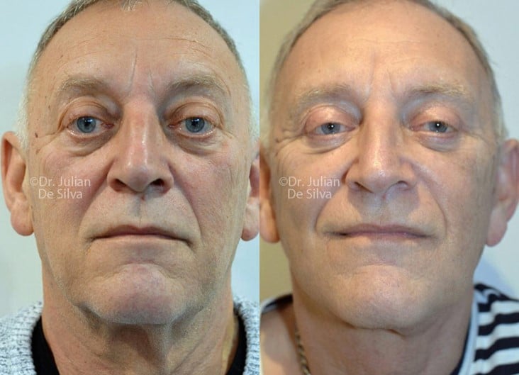 Male face, before and after Face Lift treatment, front view, patient 2