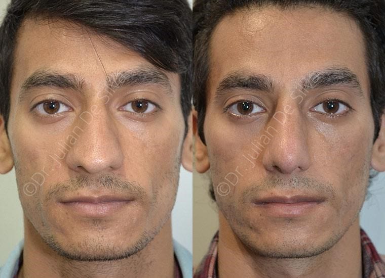 Male face, before and after Nose Jobs treatment, front view, patient 1