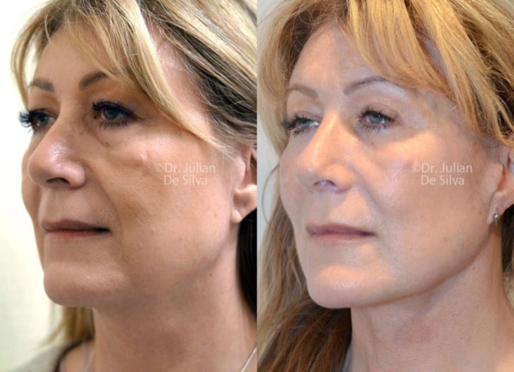 Female face, before and after Face Lift treatment, oblique view, patient 4