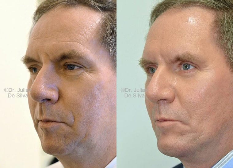 Male face, before and after Mini-Facelift treatment, oblique view, patient 2