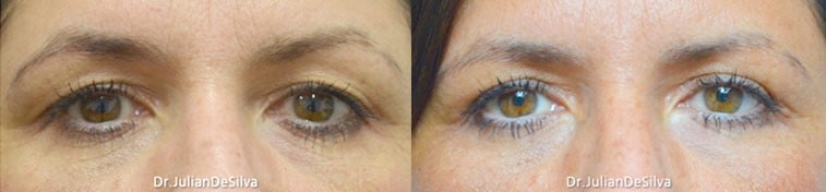 Before and After Crow’s Feet and Under Eye Wrinkles Surgery Photos, front view, patient 2