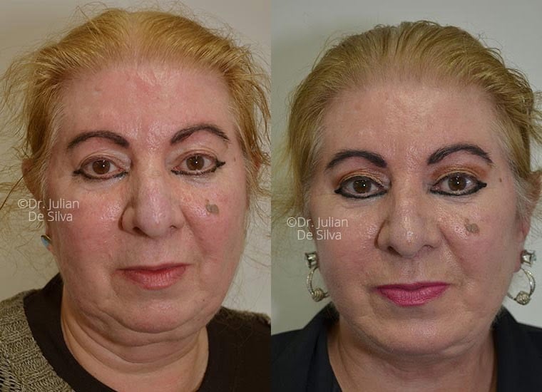 Female face, before and after Neck Lifting treatment, front view, patient 1