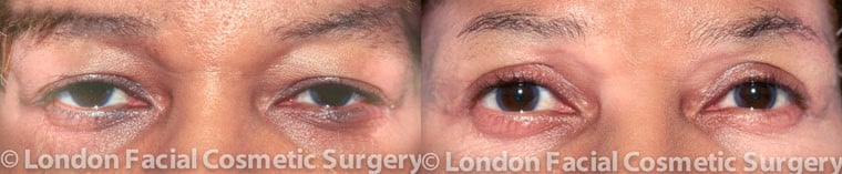 Patient 1 - Before and After blepharoplasty