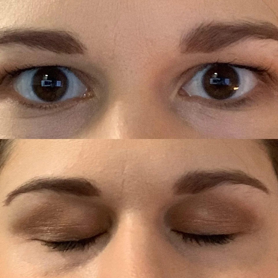 What Causes Hooded Eyes? - womans eyes before and after treatment