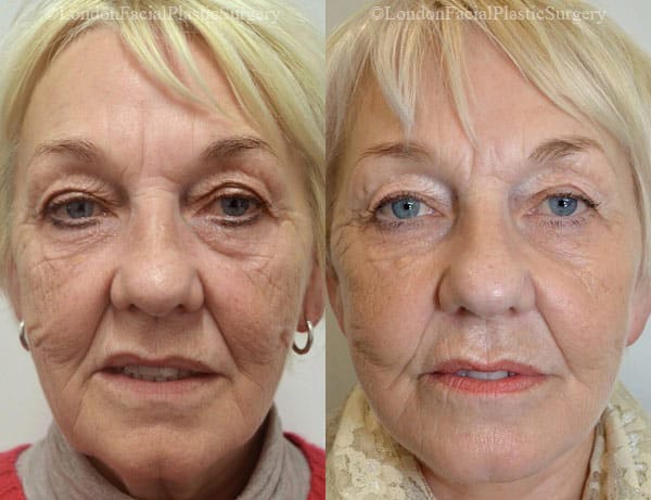 Female face, before and after Deep Plane Facelift treatment, front view, patient 5