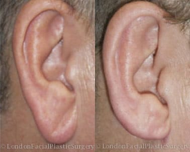 Otoplasty & Ear Pinning Before & After Results in London