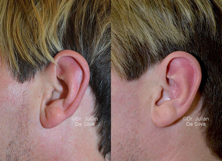Otoplasty & Ear Pinning Before & After Results in London