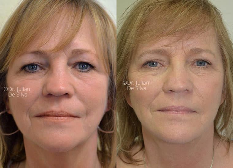 Before and After Photos: Female Facelift-and-NeckLift