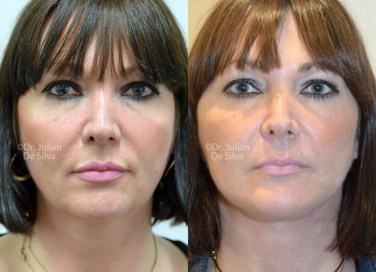 Knowing the benefits of each kind of facelift lets you find out the best one for you. 