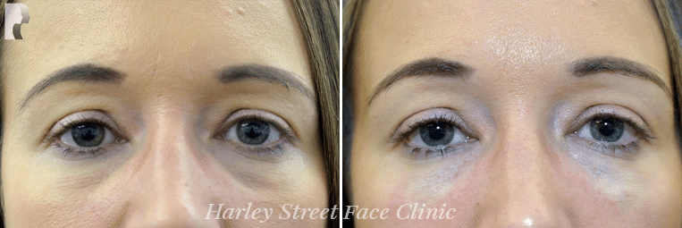The brow and forehead lift lifts sagging brows and foreheads, improving droopy eyelids.