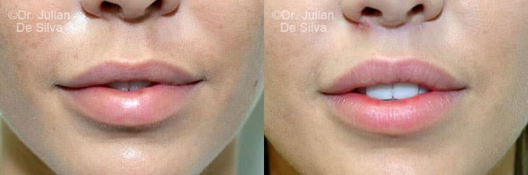 Lip Augmentation & Reduction Before & After Results in London