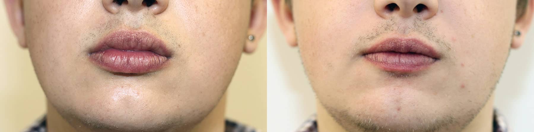 Lip Augmentation & Reduction Before & After Results in London