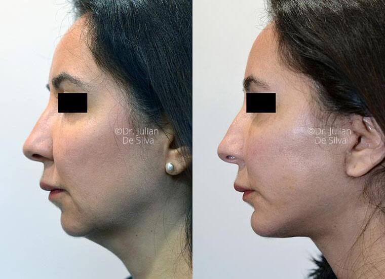 How much does a facelift cost?