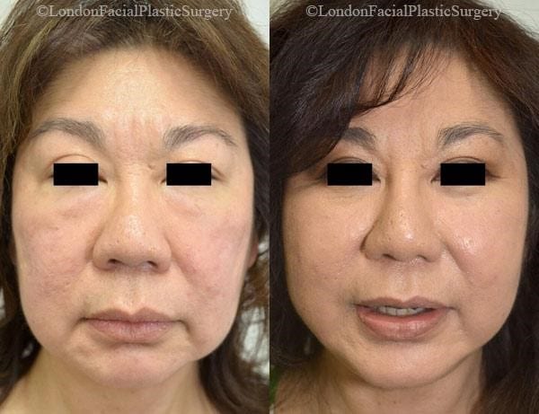Female face, before and after Mini Facelift treatment, front view, patient 9