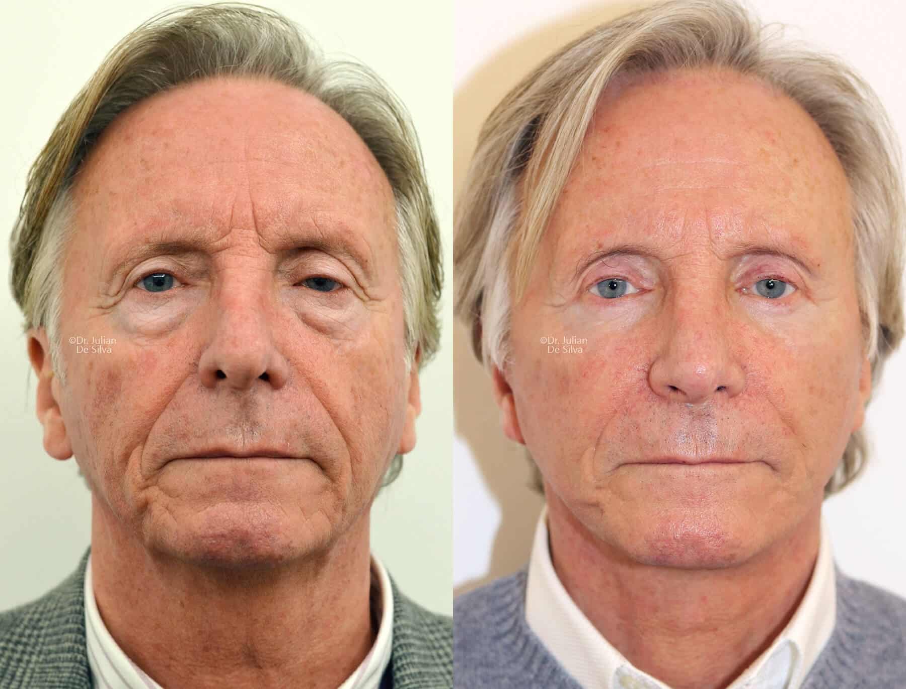 Male face, before and after Mini Facelift treatment, front view, patient 10