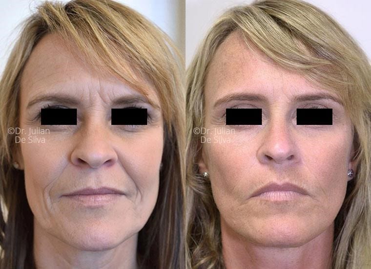 Female face, before and after Mini Facelift treatment, front view, patient 11