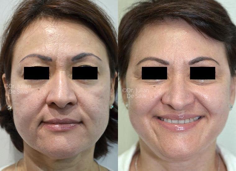Female face, before and after Mini Facelift treatment, front view, patient 13