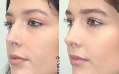 Everything You Should Consider Before Getting a Nose Job