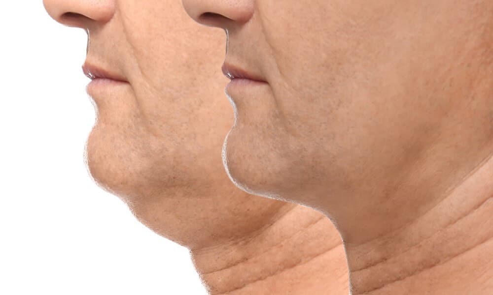 You can choose from many treatments to get rid of the fat under your chin.