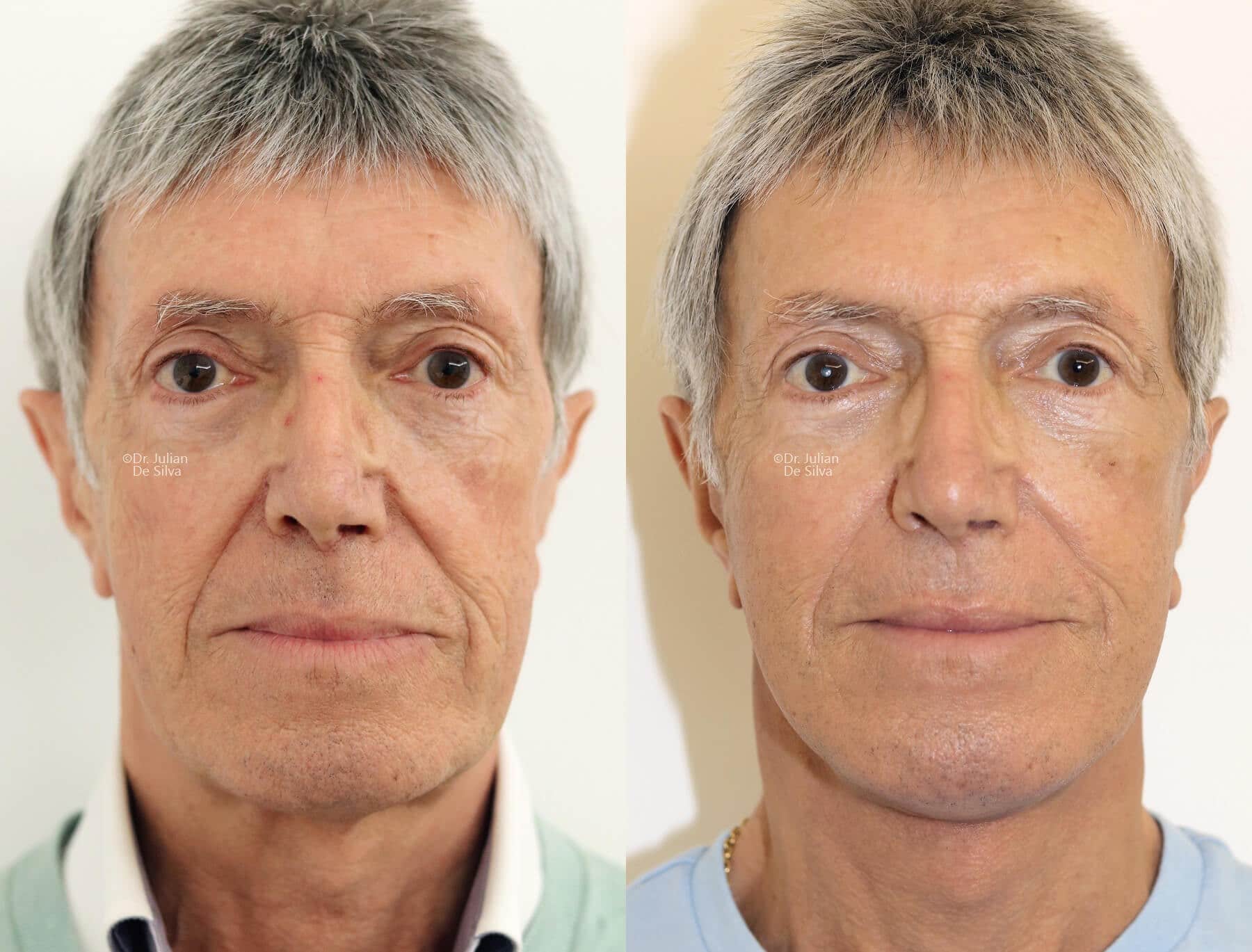 Male face, before and after Mini Facelift treatment, front view, patient 14