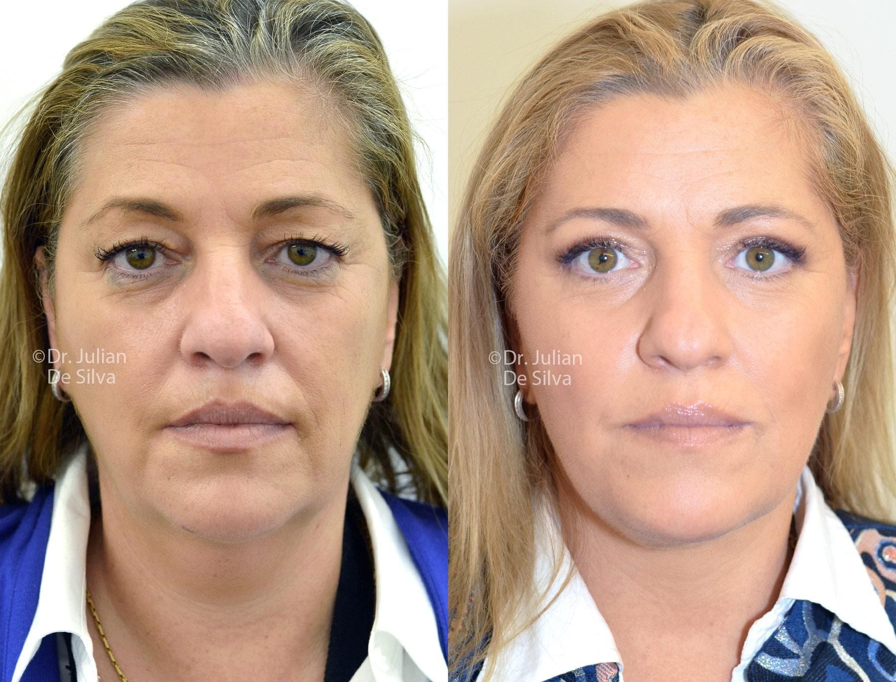 Female face, before and after Mini Facelift treatment, front view, patient 17