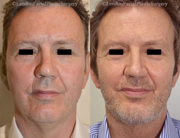 Male face, before and after Mini Facelift treatment, front view, patient 18